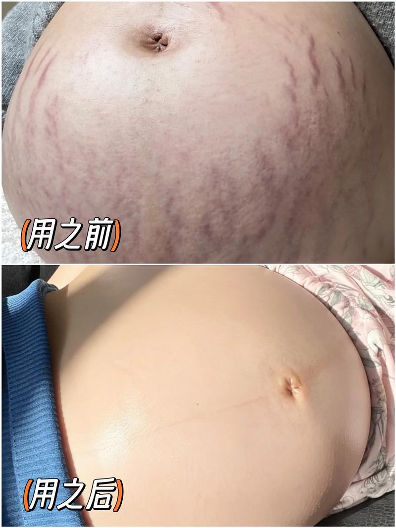 什么是妊辰纹