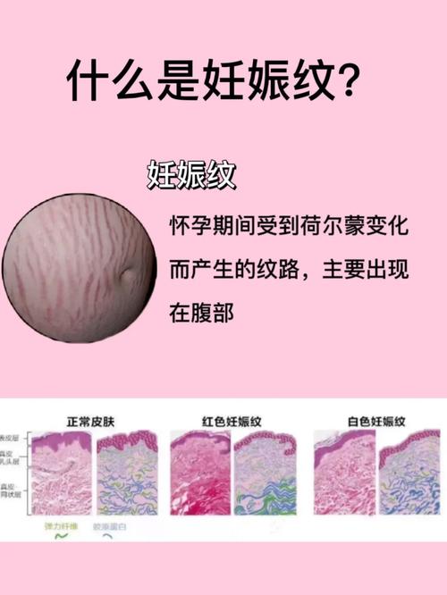 什么是妊辰纹