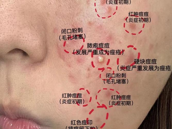 为什么老是起粉刺