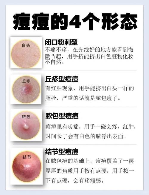 脸上为什么粉刺