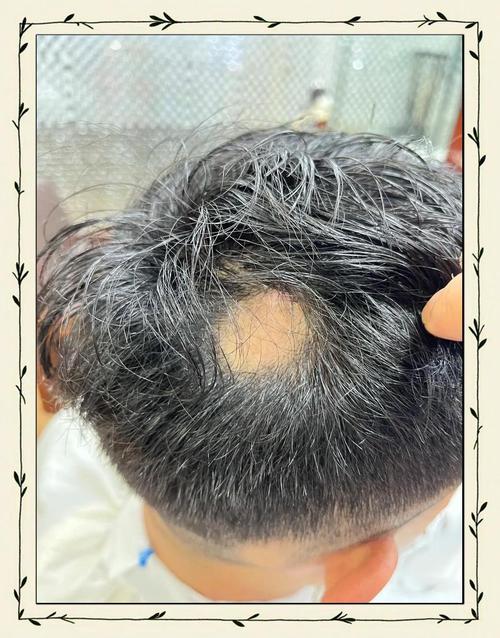为什么会得斑秃