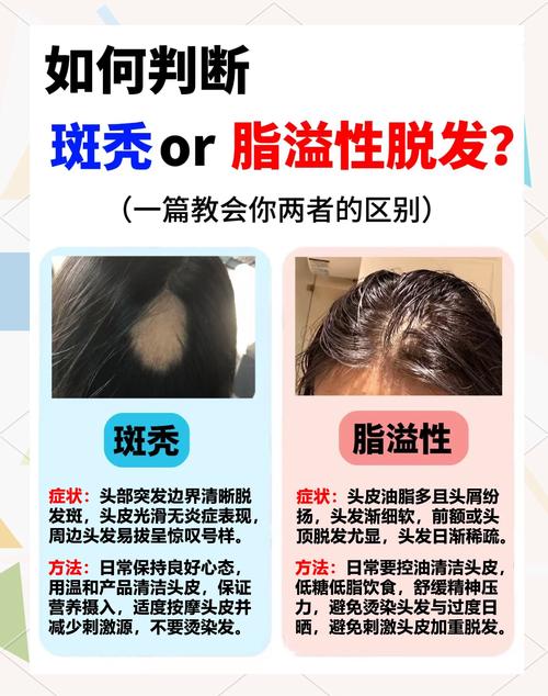 为什么会得斑秃