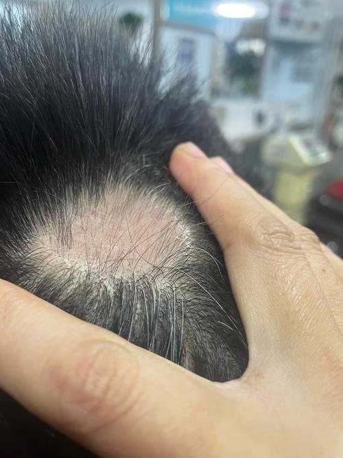 为什么会得斑秃