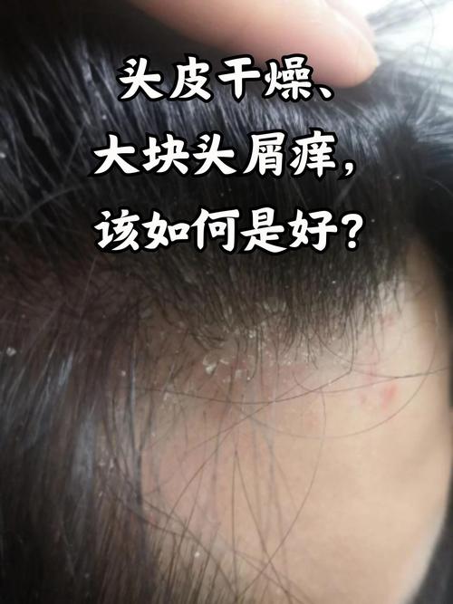 冬天为什么头皮屑多