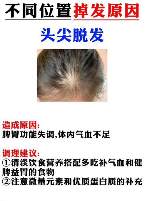 额头脱发是什么原因
