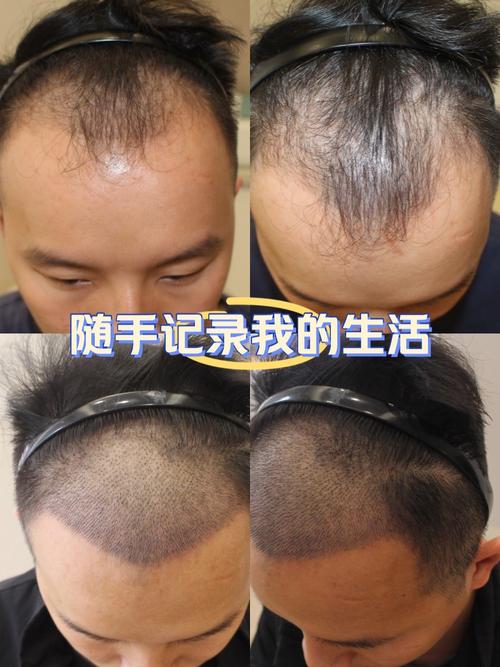 额头脱发是什么原因