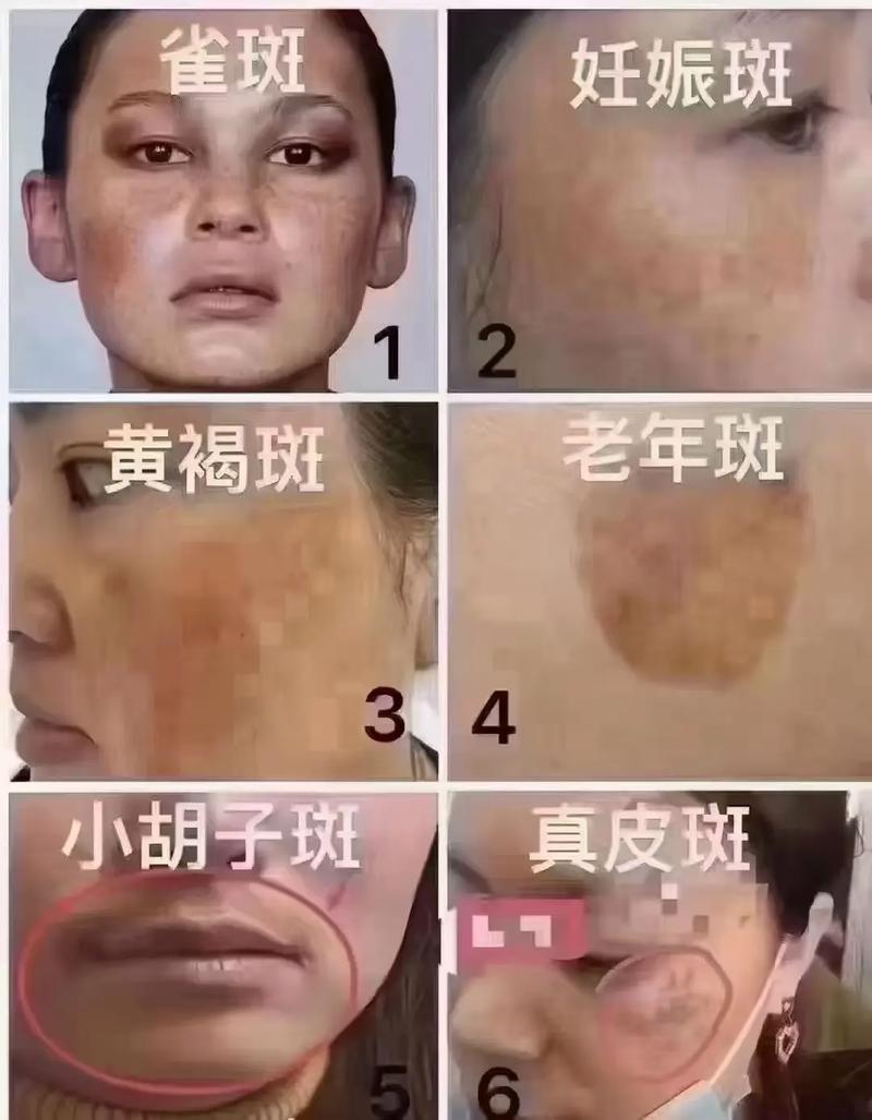 什么是蝴蝶斑