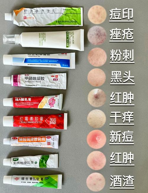 祛痘什么效果好