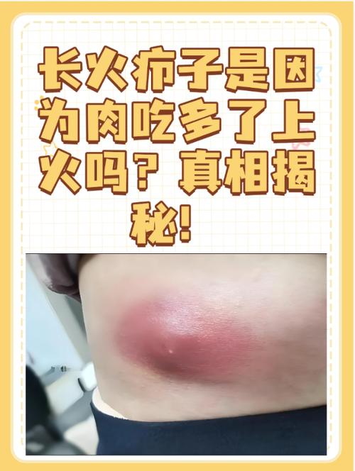 什么是火疙瘩
