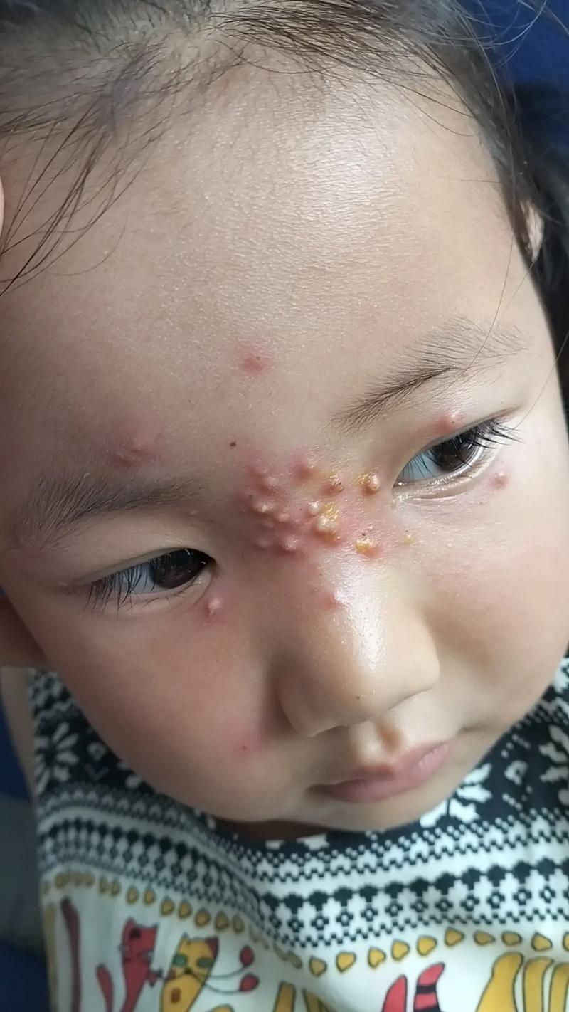 什么是火疙瘩