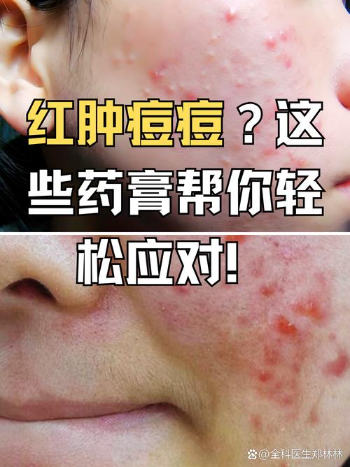 红痘痘是什么