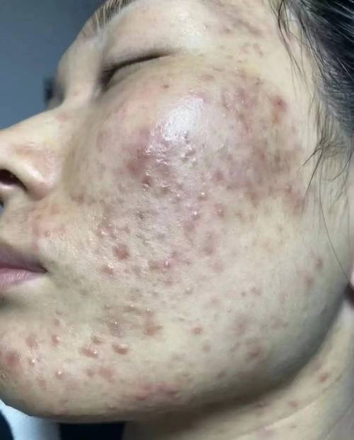 红痘痘是什么