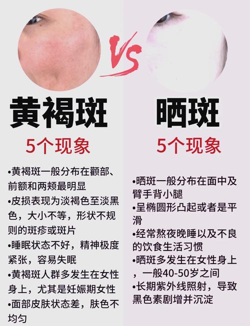 为什么会长晒斑