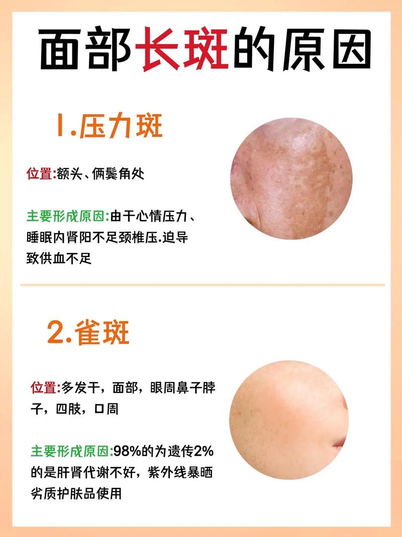 男人为什么长斑