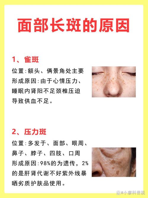 男人为什么长斑