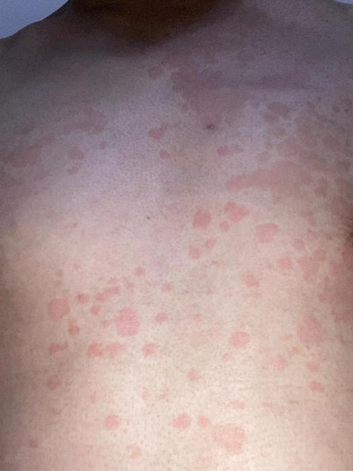 花斑癣是什么症状