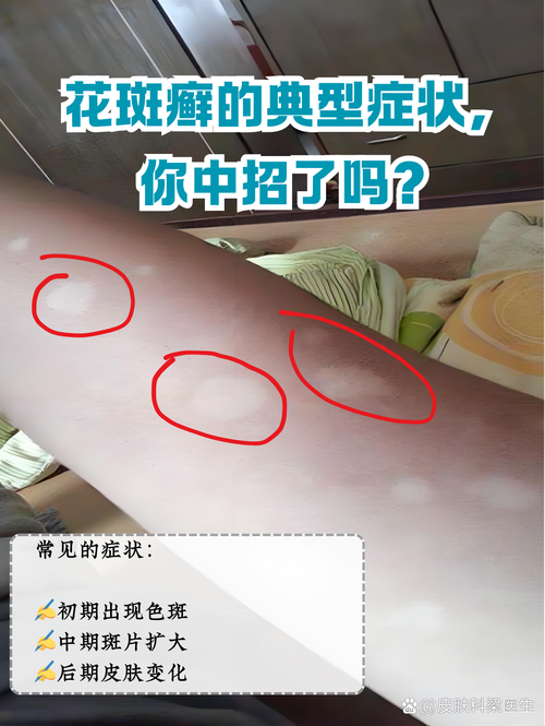 花斑癣是什么症状