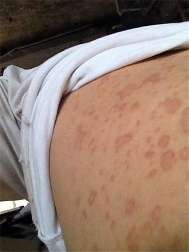 花斑癣是什么症状