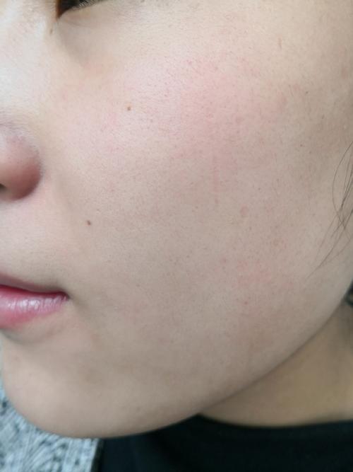 化妆品过敏什么症状