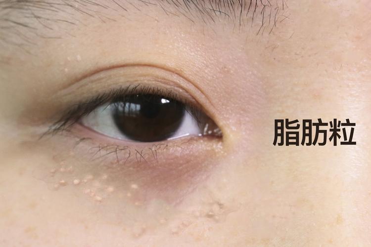 什么叫脂肪粒