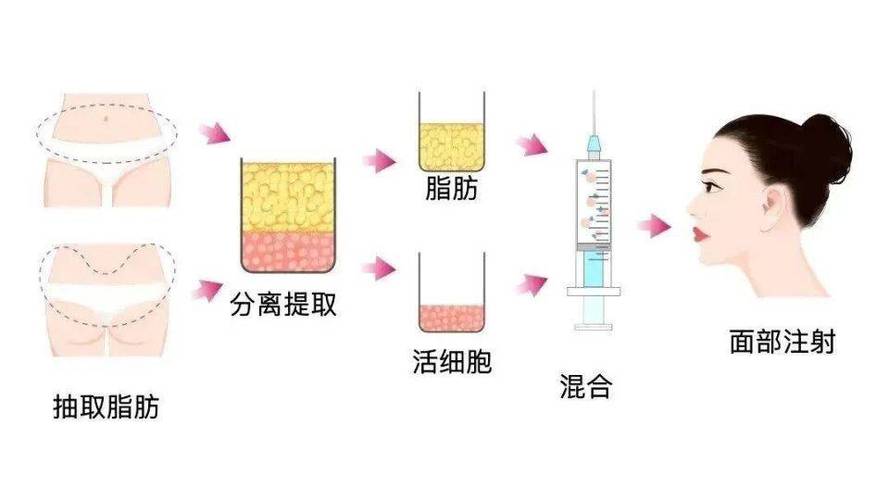 脂肪填充有什么危害