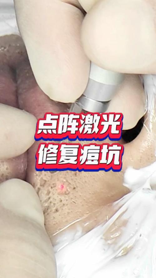 什么激光祛痘