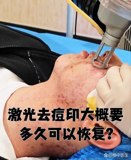 什么激光祛痘