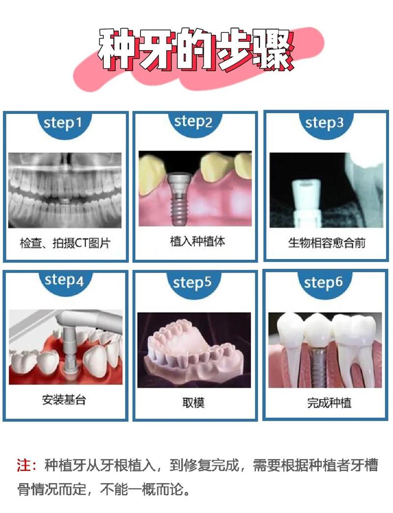 种植牙齿是什么意思