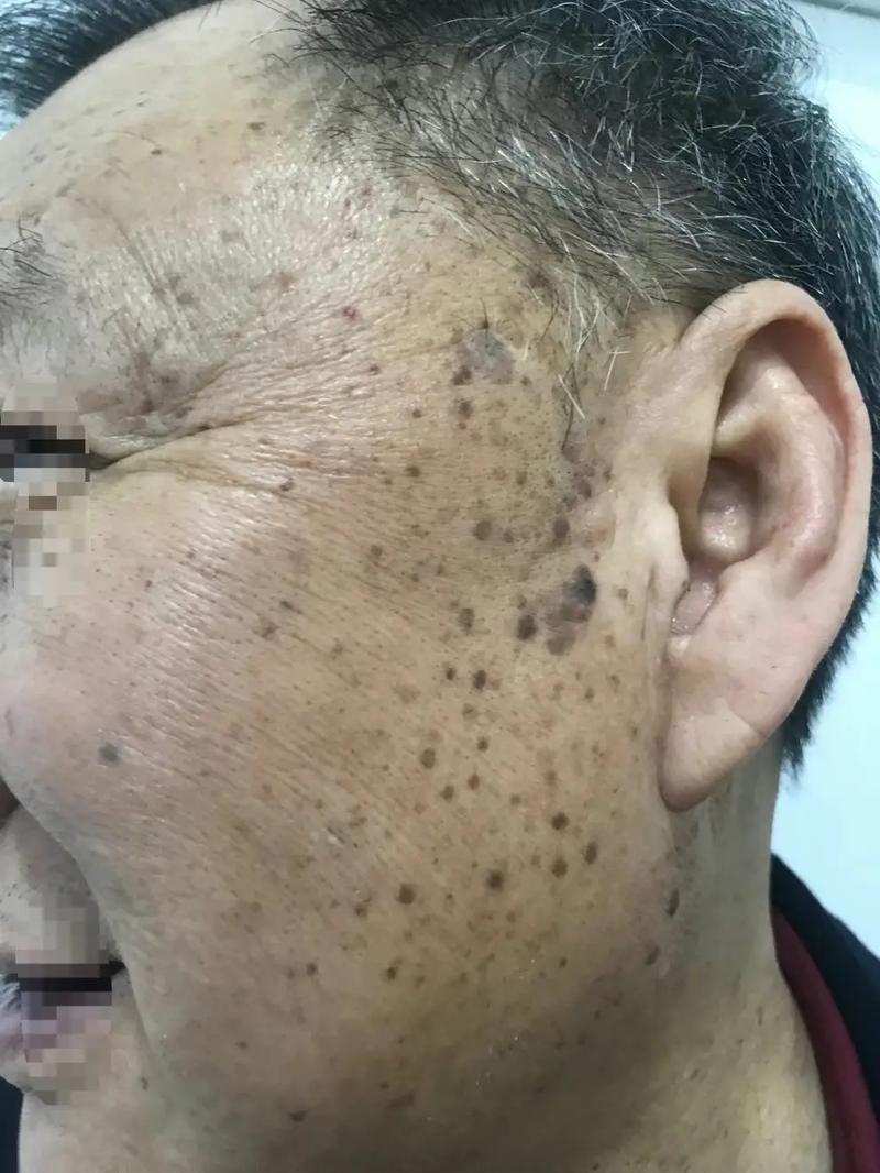 为什么有老人斑