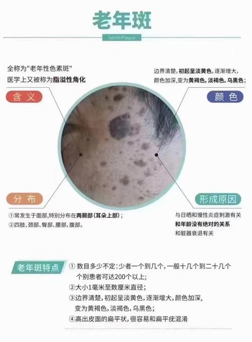 为什么有老人斑