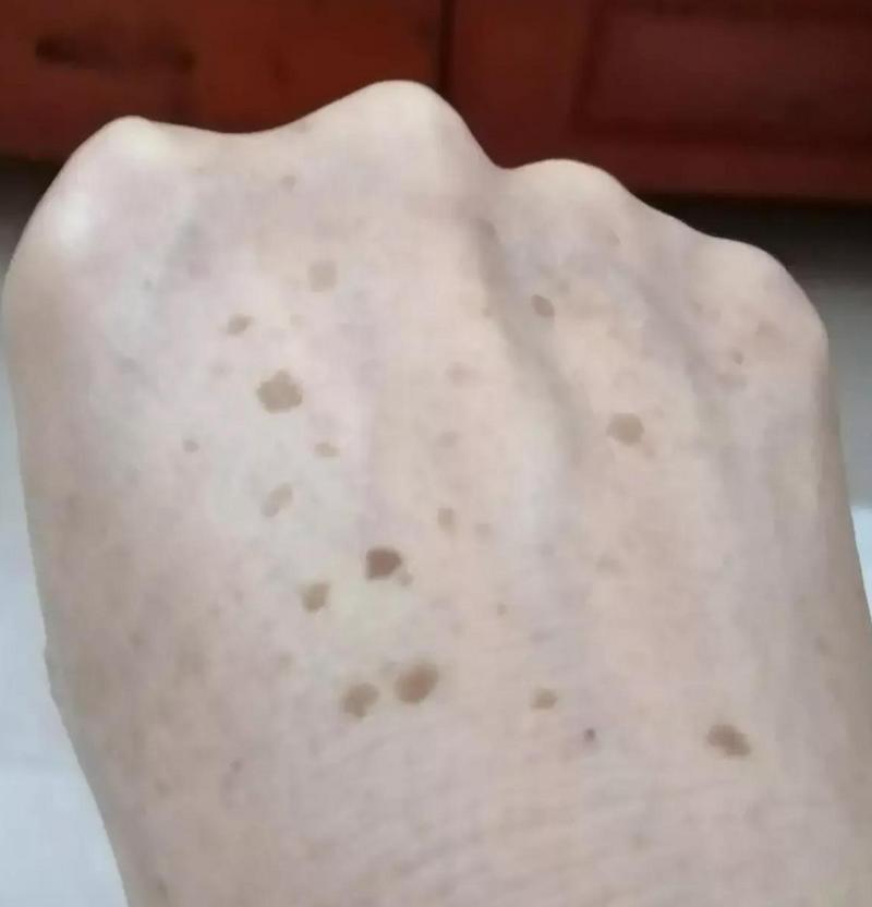 为什么有老人斑