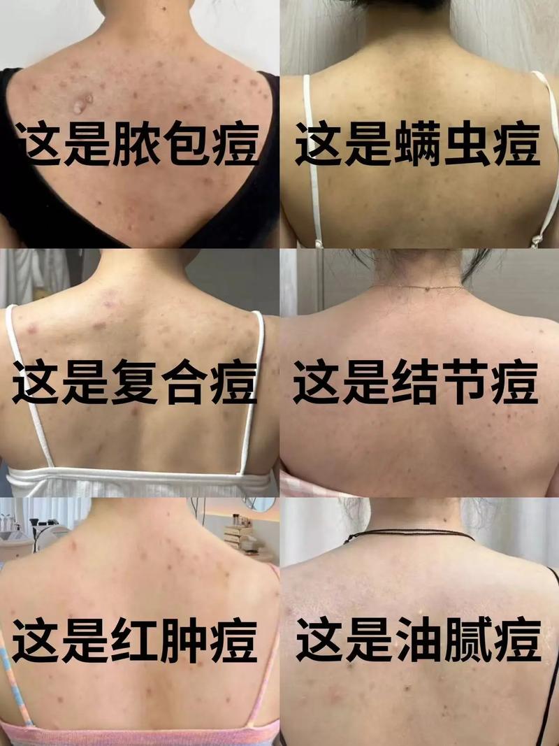 背上长痘是为什么