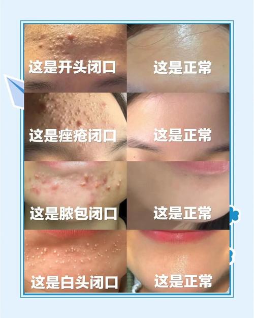 去闭口什么意思