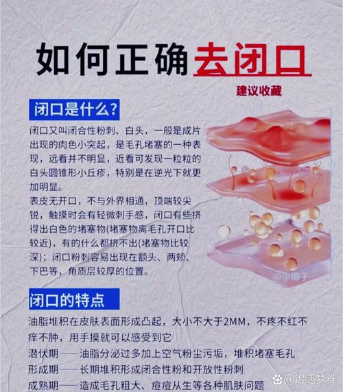 去闭口什么意思