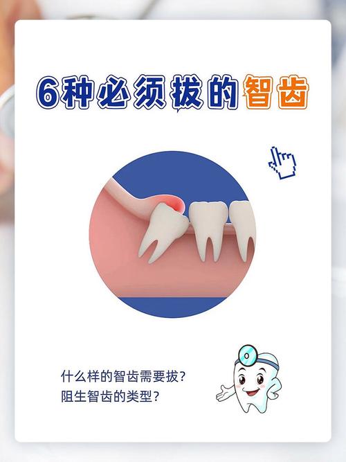 什么智齿要拔
