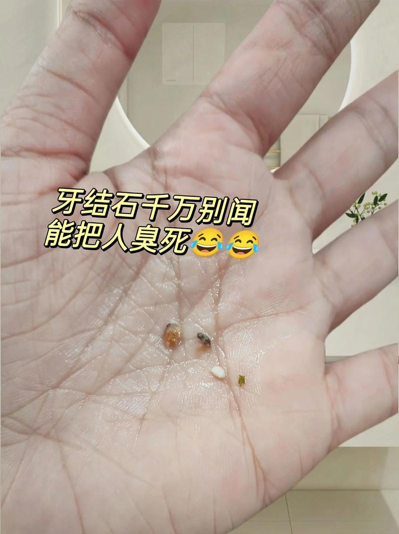 牙结石是什么引起的