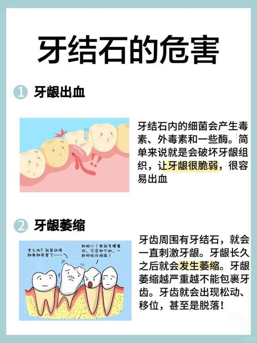 牙结石是什么引起的
