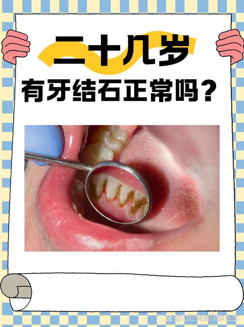 牙结石是什么引起的