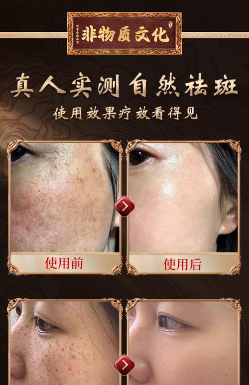 黄褐斑用什么激光