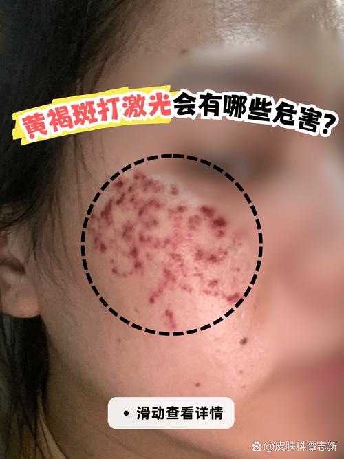 黄褐斑用什么激光