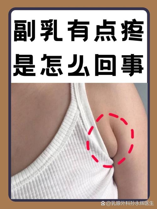 副乳为什么会疼