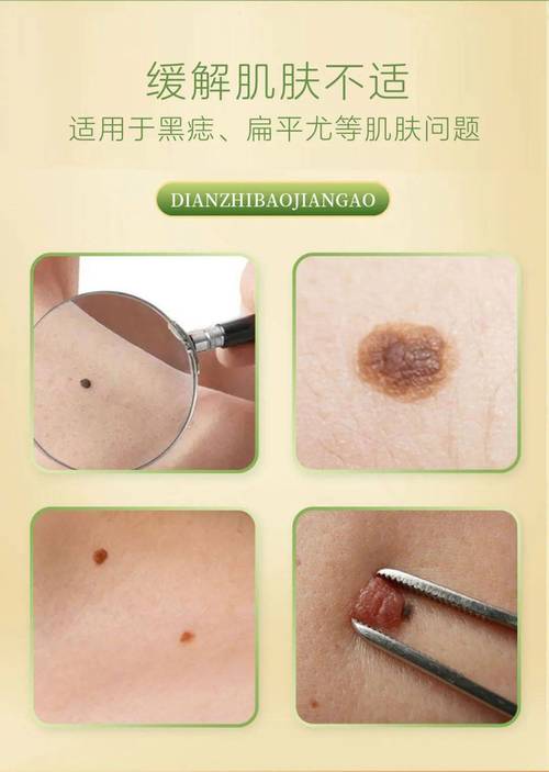 什么东西可以去痣