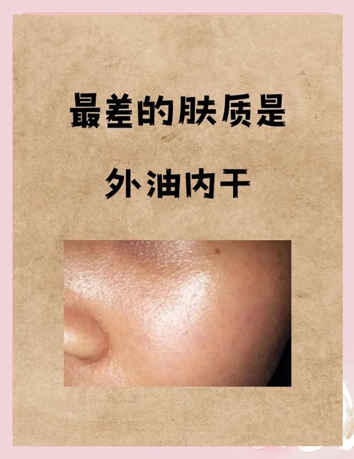 什么叫油性皮肤