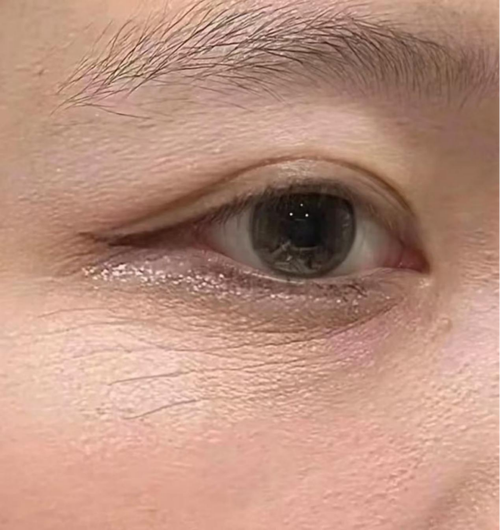 什么是干纹