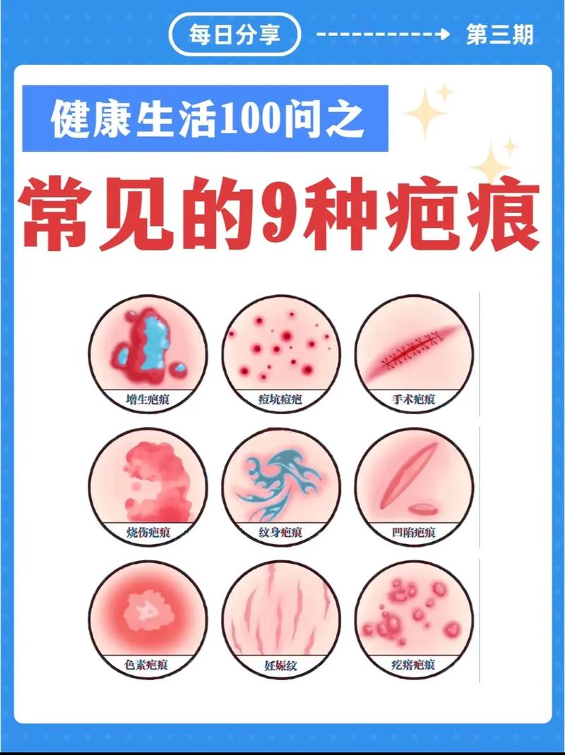 癫痕是什么
