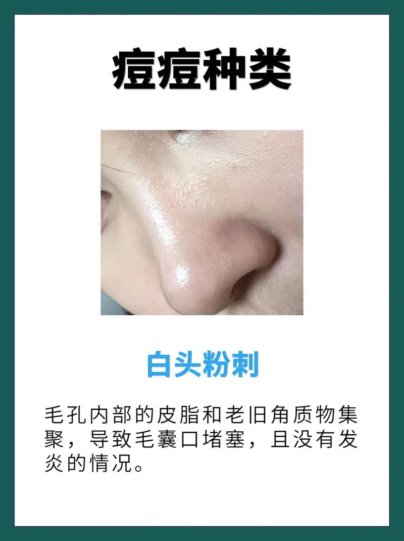 什么是白头粉刺