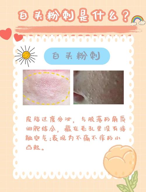 什么是白头粉刺
