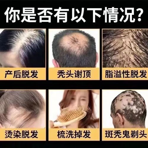 掉头发可以吃什么药
