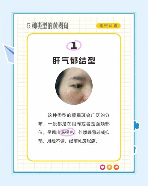 长蝴蝶斑什么原因