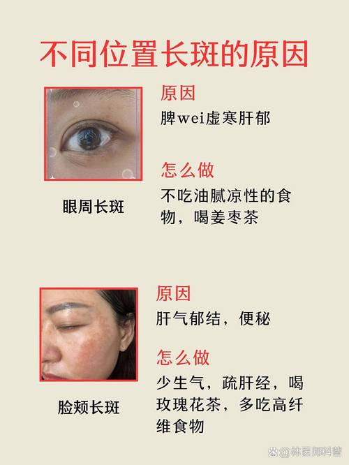 长蝴蝶斑什么原因